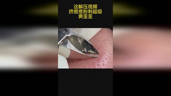 最新擠膿包視頻，見證變化的力量，自信與成就感的誕生之地