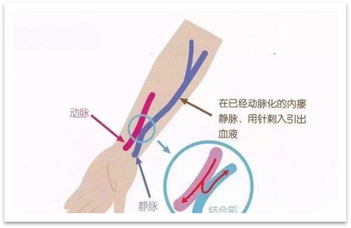 靜脈瘺最新資訊，掌握最前沿的健康信息